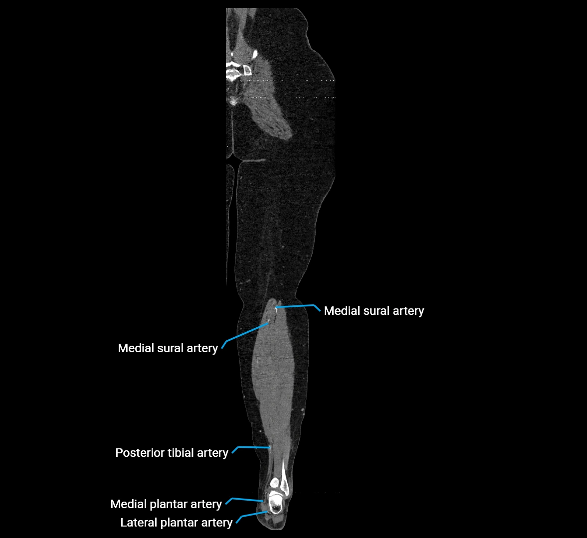 CTA lower limb coronal cross sectional anatomy labelled image _76 (2).webp